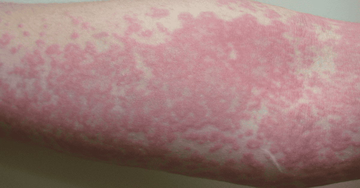 Rimas Kulit Gatal Sebab Gegata? 7 Punca Berlakunya Gegata!